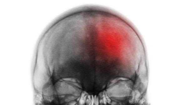 Xray image of cerebral stroke